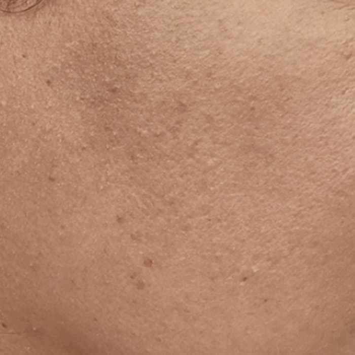 Cheek and jawline, before and after — after