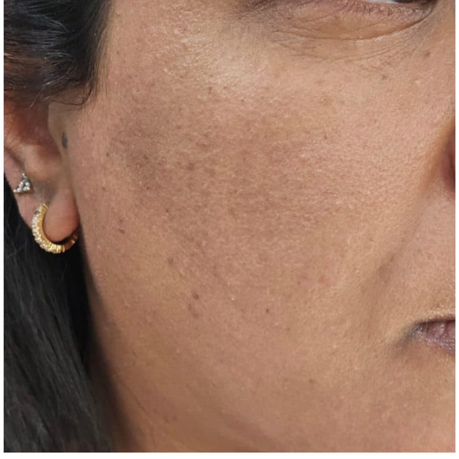 Cheek and jawline, before and after eighteen days of use — after